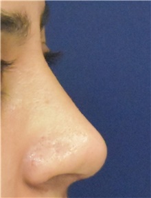 Rhinoplasty After Photo by Richard Reish, MD, FACS; New York, NY - Case 45285