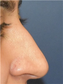 Rhinoplasty Before Photo by Richard Reish, MD, FACS; New York, NY - Case 45285