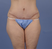 Tummy Tuck After Photo by Katerina Gallus, MD, FACS; San Diego, CA - Case 45322