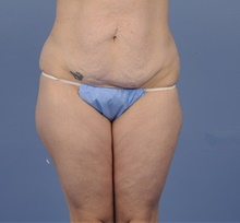 Tummy Tuck Before Photo by Katerina Gallus, MD, FACS; San Diego, CA - Case 45322