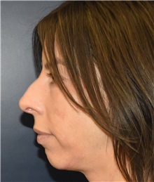 Chin Augmentation Before Photo by Richard Reish, MD, FACS; New York, NY - Case 45327