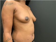 Breast Augmentation Before Photo by Johnny Franco, MD; Austin, TX - Case 45433