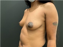 Breast Augmentation Before Photo by Johnny Franco, MD; Austin, TX - Case 45433