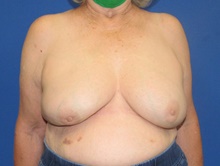 Breast Implant Removal After Photo by Katerina Gallus, MD, FACS; San Diego, CA - Case 45464