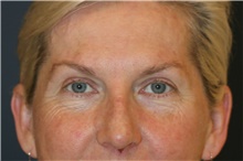 Brow Lift After Photo by Steve Laverson, MD, FACS; Rancho Santa Fe, CA - Case 45489