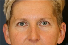 Brow Lift Before Photo by Steve Laverson, MD, FACS; Rancho Santa Fe, CA - Case 45489