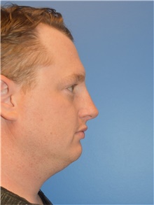 Rhinoplasty After Photo by Adam Weinfeld, MD; Austin, TX - Case 45607