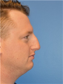 Rhinoplasty Before Photo by Adam Weinfeld, MD; Austin, TX - Case 45607