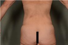 Body Lift Before Photo by Ellen Janetzke, MD; Bloomfield Hills, MI - Case 45628