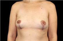 Breast Implant Removal After Photo by Landon Pryor, MD, FACS; Rockford, IL - Case 45672