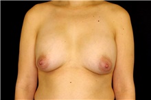 Breast Implant Removal Before Photo by Landon Pryor, MD, FACS; Rockford, IL - Case 45672