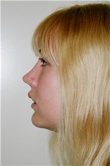 Chin Augmentation After Photo by Steve Laverson, MD, FACS; Rancho Santa Fe, CA - Case 45711