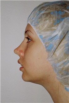 Chin Augmentation Before Photo by Steve Laverson, MD, FACS; Rancho Santa Fe, CA - Case 45711