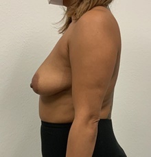 Breast Lift Before Photo by Johnny Franco, MD; Austin, TX - Case 45724