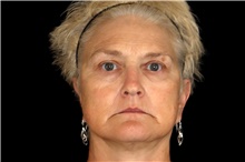 Brow Lift Before Photo by Landon Pryor, MD, FACS; Rockford, IL - Case 45834