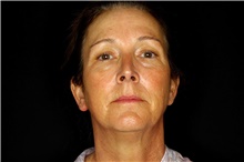 Brow Lift Before Photo by Landon Pryor, MD, FACS; Rockford, IL - Case 45887