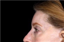 Brow Lift After Photo by Landon Pryor, MD, FACS; Rockford, IL - Case 45891