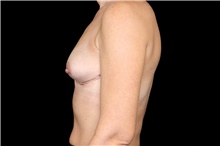 Breast Implant Removal After Photo by Landon Pryor, MD, FACS; Rockford, IL - Case 45897