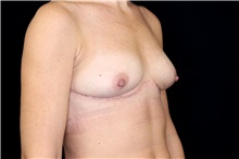 Breast Implant Removal After Photo by Landon Pryor, MD, FACS; Rockford, IL - Case 45897