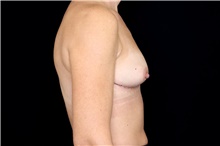 Breast Implant Removal After Photo by Landon Pryor, MD, FACS; Rockford, IL - Case 45897