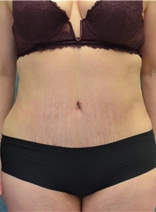 Tummy Tuck After Photo by Mark McRae, MD, FRCS(C); Burlington, ON - Case 45902