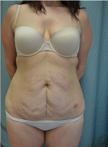 Tummy Tuck Before Photo by Mark McRae, MD, FRCS(C); Burlington, ON - Case 45902