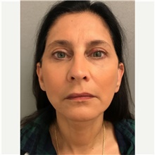 Facelift After Photo by Franklin Richards, MD; Bethesda, MD - Case 46133