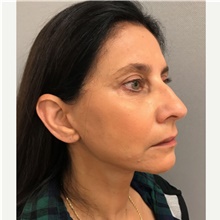 Facelift After Photo by Franklin Richards, MD; Bethesda, MD - Case 46133