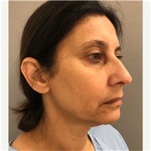 Facelift Before Photo by Franklin Richards, MD; Bethesda, MD - Case 46133