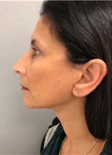 Facelift After Photo by Franklin Richards, MD; Bethesda, MD - Case 46133