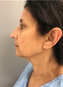 Facelift Before Photo by Franklin Richards, MD; Bethesda, MD - Case 46133