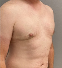 Male Breast Reduction After Photo by Keshav Magge, MD; Bethesda, MD - Case 46157