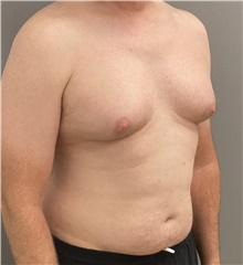 Male Breast Reduction Before Photo by Keshav Magge, MD; Bethesda, MD - Case 46157