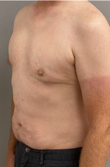 Male Breast Reduction After Photo by Keshav Magge, MD; Bethesda, MD - Case 46157