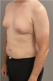 Male Breast Reduction Before Photo by Keshav Magge, MD; Bethesda, MD - Case 46157