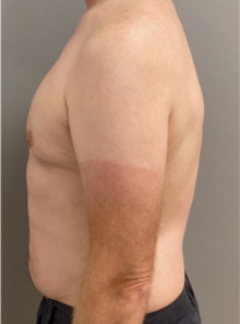 Male Breast Reduction After Photo by Keshav Magge, MD; Bethesda, MD - Case 46157