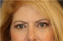 Brow Lift After Photo by Steve Laverson, MD, FACS; Rancho Santa Fe, CA - Case 46205