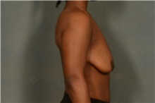 Breast Augmentation Before Photo by Ellen Janetzke, MD; Bloomfield Hills, MI - Case 46272