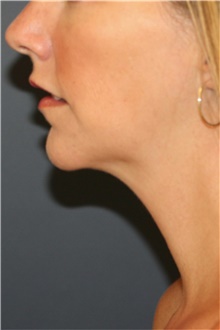 Chin Augmentation After Photo by Steve Laverson, MD, FACS; Rancho Santa Fe, CA - Case 46352