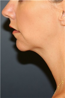 Chin Augmentation Before Photo by Steve Laverson, MD, FACS; Rancho Santa Fe, CA - Case 46352