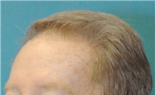 Hair Transplant After Photo by Scott Sattler, MD,  FACS; Seattle, WA - Case 46394