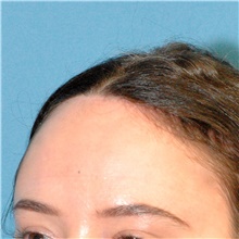 Hair Transplant Before Photo by Scott Sattler, MD,  FACS; Seattle, WA - Case 46424