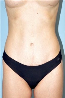 Tummy Tuck After Photo by Keyian Paydar, MD, FACS; Newport Beach, CA - Case 46583