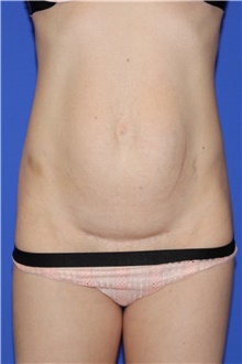 Tummy Tuck Before Photo by Keyian Paydar, MD, FACS; Newport Beach, CA - Case 46583