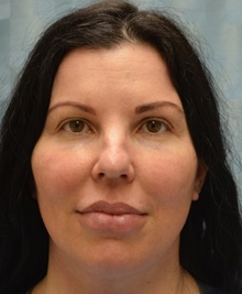 Brow Lift After Photo by Mark McRae, MD, FRCS(C); Burlington, ON - Case 46672