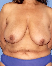 Breast Lift Before Photo by Siamak Agha, MD PhD FACS; Newport Beach, CA - Case 46682