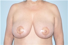 Breast Lift After Photo by Keyian Paydar, MD, FACS; Newport Beach, CA - Case 46823