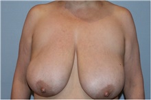 Breast Lift Before Photo by Keyian Paydar, MD, FACS; Newport Beach, CA - Case 46823