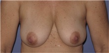 Body Lift Before Photo by Keyian Paydar, MD, FACS; Newport Beach, CA - Case 46825