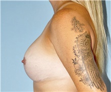 Breast Lift After Photo by Keyian Paydar, MD, FACS; Newport Beach, CA - Case 46827